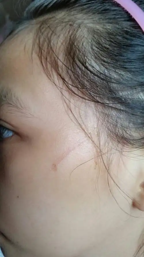 小女孩的脸,被小朋友抓伤留下疤痕,有什麼药能改善,求妙方,谢谢.