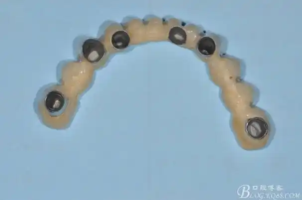 上颌双套冠下颌固定桥种植与修复一例