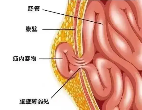 什么是腹股沟疝腹股沟疝俗称"疝气",是普外科的常见疾病,好发于中老年