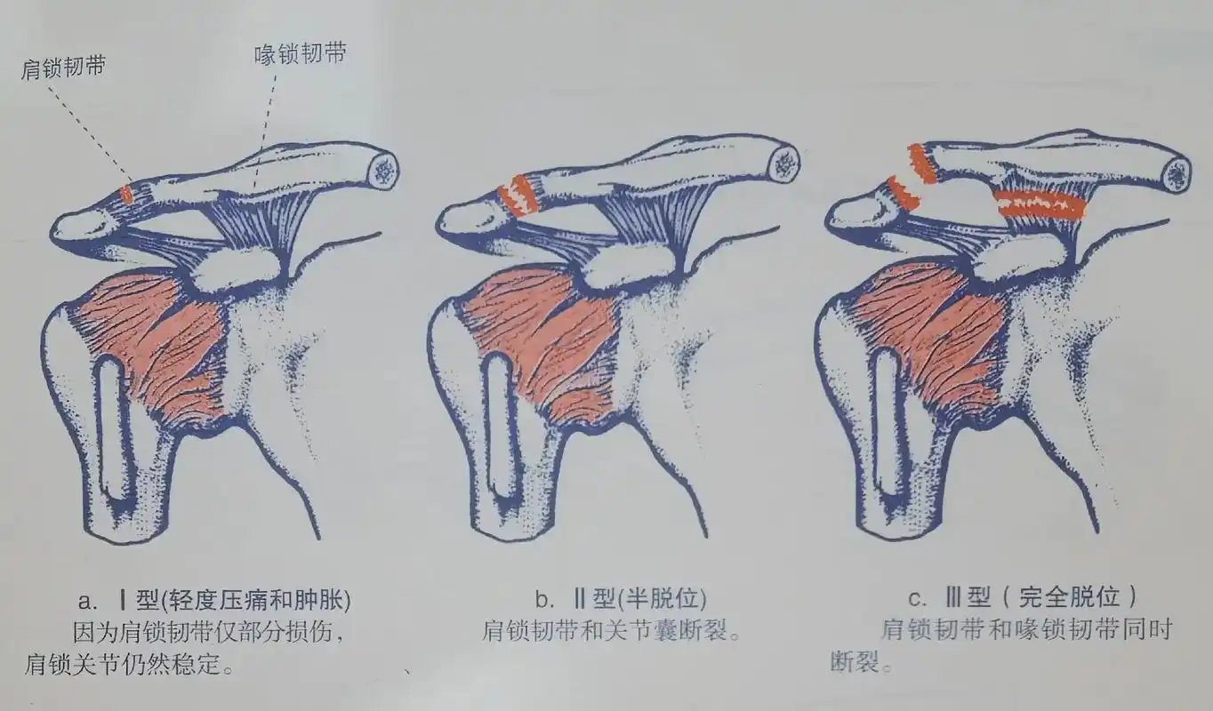今天图文科普,肩锁关节脱位,从分型,拍摄通通告诉你们9595 - 抖音
