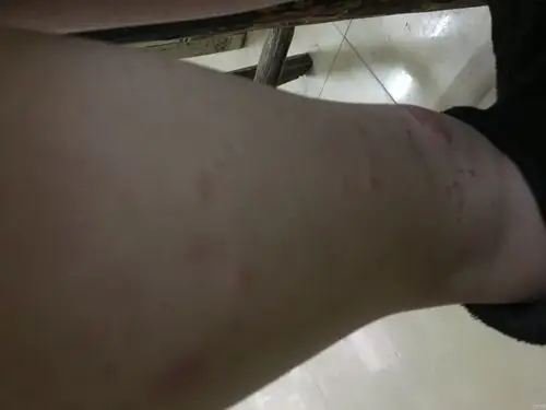 双下肢瘀点瘀癍4小时(原创)