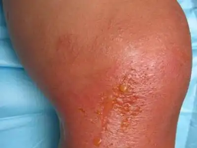 蔬菜皮炎 疾病知识 医疗资源 饮食宜忌 相关图册 轻者,趾间皮肤呈浸渍