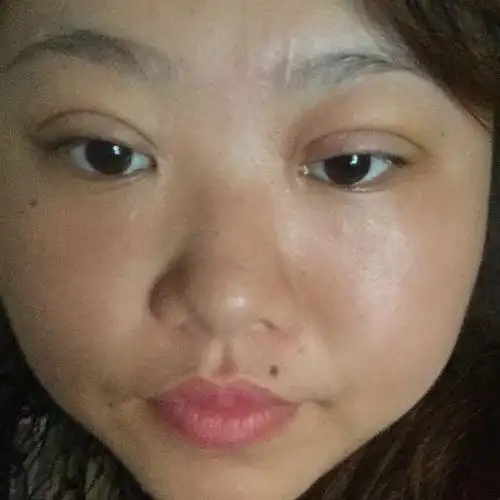 埋线双眼皮做了7天,感觉大小眼,正常吗?