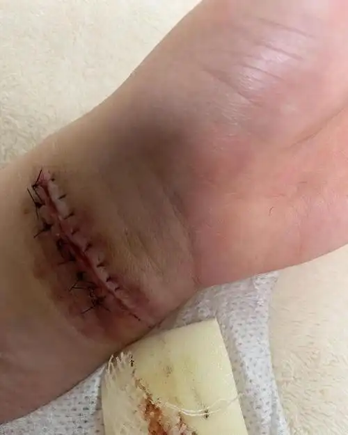 阴影难消aoa前成员权珉娥再次割腕自杀神经线断了不打麻药缝合