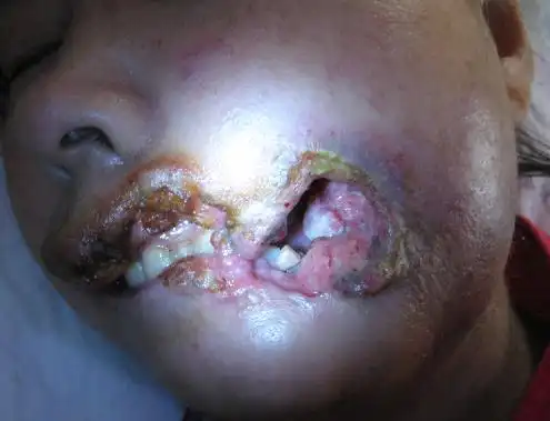 口腔癌的早期症状图(51)