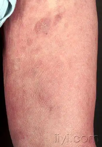 皮肤临床病理08蕈样霉菌病