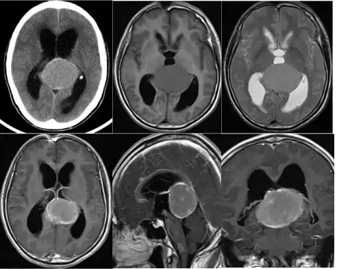 一个月前出现头晕,视力下降,视物模糊,去当地医院就诊,头颅磁共振示