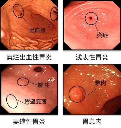 有急慢性胃炎,需要做胃镜的患者.