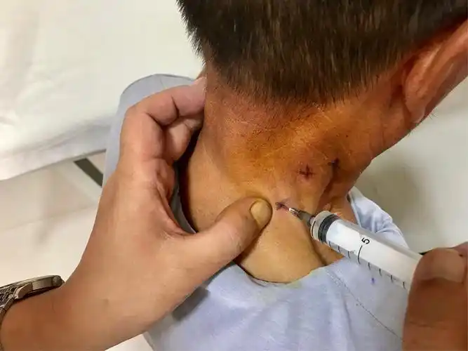 肩胛背神经卡压神经阻滞治疗