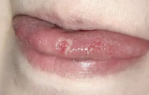 07.14复诊-系统性红斑狼疮康复圈-觅健