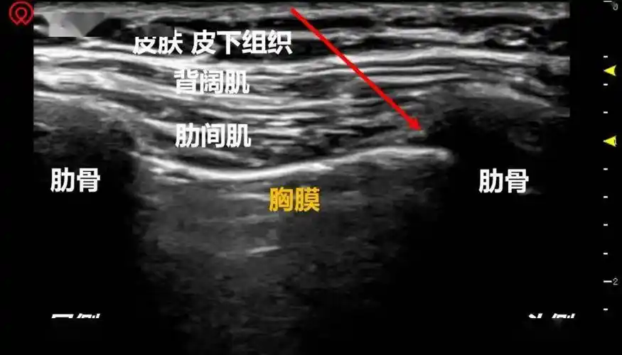 肋间神经阻滞扫查体位【超声定位】可以根据体表标志定位(同前锯肌