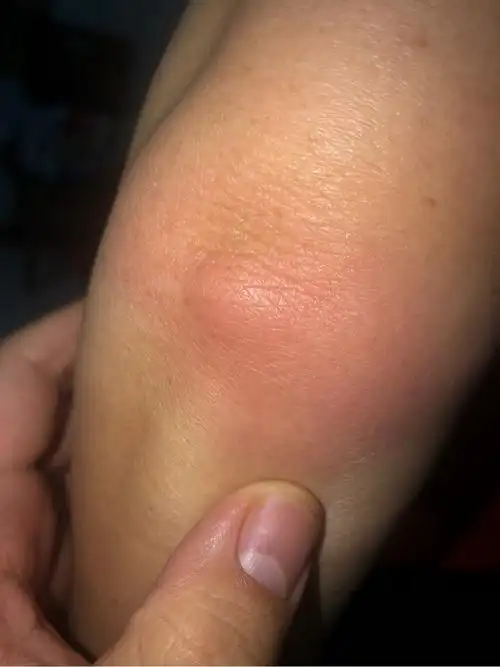 是淋巴瘤吗胳膊肘外侧红肿