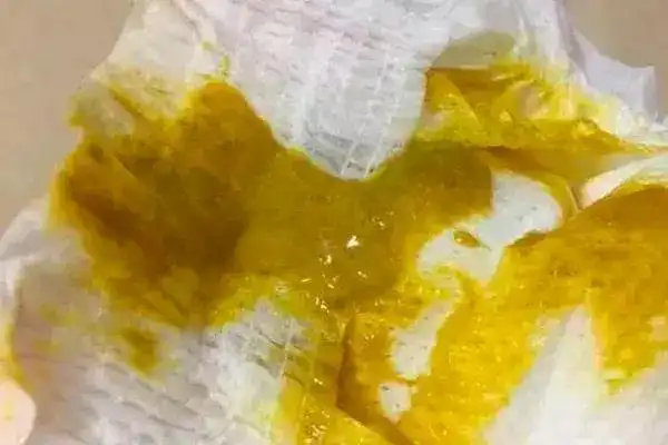 大便里的粘液就是肠粘膜脱落,在肠胃炎期间都会出现粘液,但如果粘液