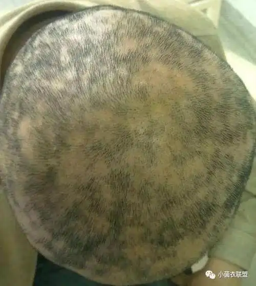小菌衣联盟图:化疗导致的生长期弥漫性脱发 非弥漫性脱发主要是指病人