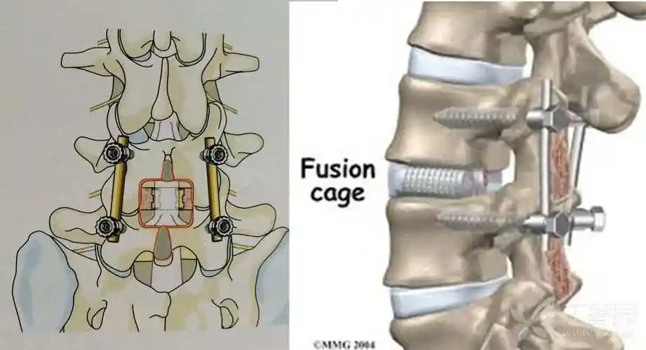 内固定plif包括单纯椎间融合(stand-alone),单侧椎弓根钉棒内固定系统