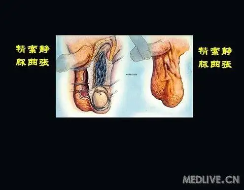 课件分享梅骅教授讲解的精索静脉曲张