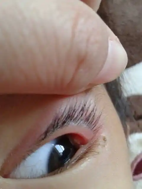 孩子眼睛尾部上内敛起了个白色的小逗,早上起来发现