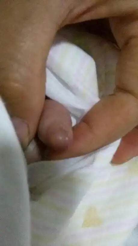 我宝宝用手抓了小鸡鸡有点肿怎么办?
