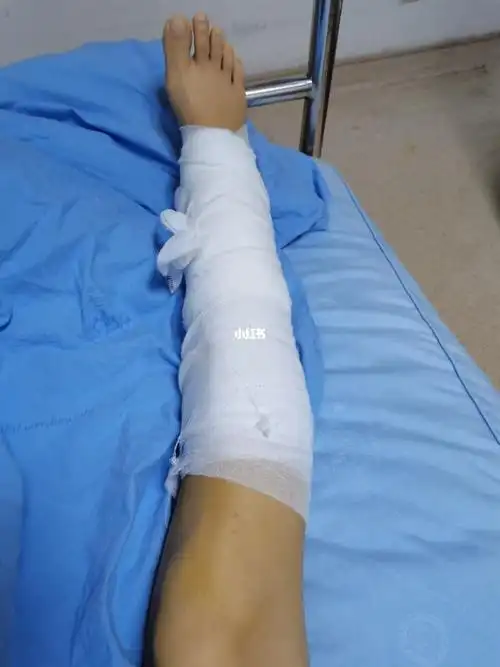 住院10天,在床上躺了10天,没下过地 浑身难受,腿已基本消肿