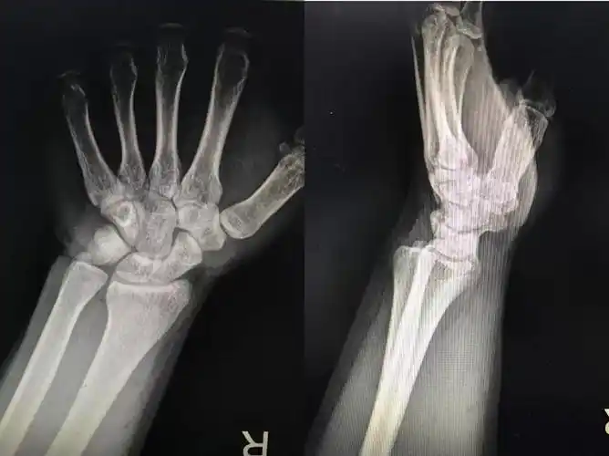 tfcc|腕关节|扭伤|疼痛|微创|-健康界