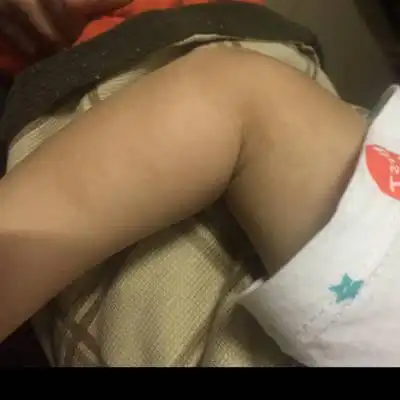 小孩一出生手臂就有大块黑色素沉淀,现在一岁半,黑色素已经到颈部了