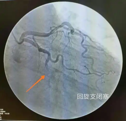 急诊造影示:回旋支闭塞