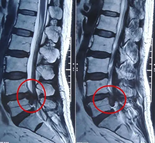 腰间盘突出症患者内镜治疗术后一年发来反馈