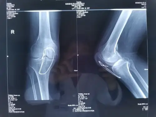 髌韧带,前后交叉韧带,外侧副韧带损伤患者
