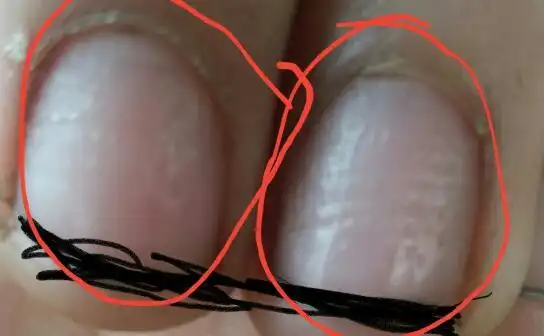 15岁男生手指头有小坑怎么回是,看图