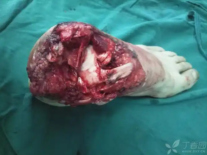 踝关节处离断再植一例 [病例帖]