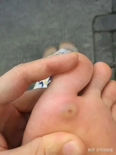 本人小姐姐一枚,长跖疣在脚底已经2个月了,以为可以自己好,实际上不