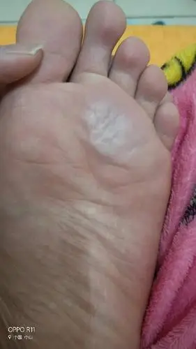 为什么脚心有白色的,还会皱起来