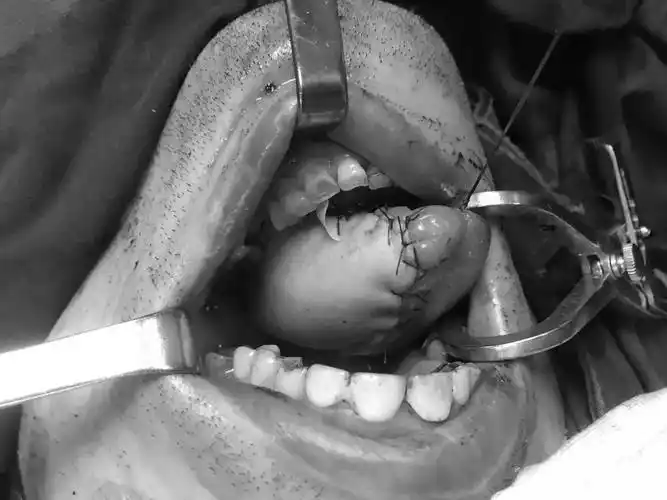 聚焦医疗技术78丨半个舌头被切竟能借大腿肉再造