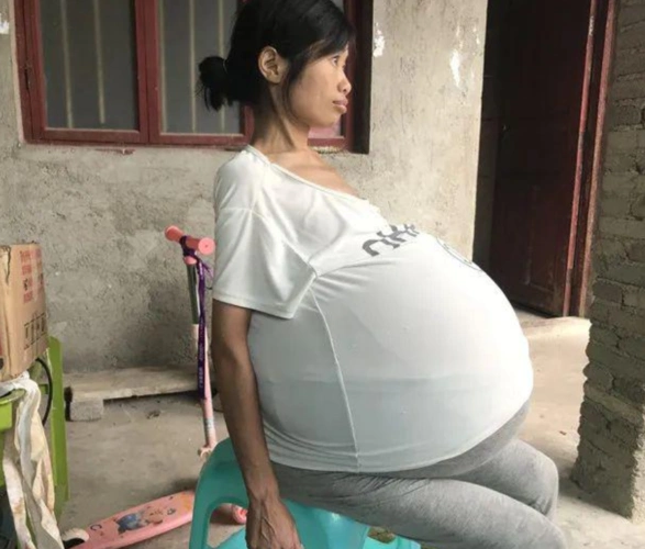 贵州女子身患多种疾病肚大如球10岁儿子撑起家希望我妈妈像正常人