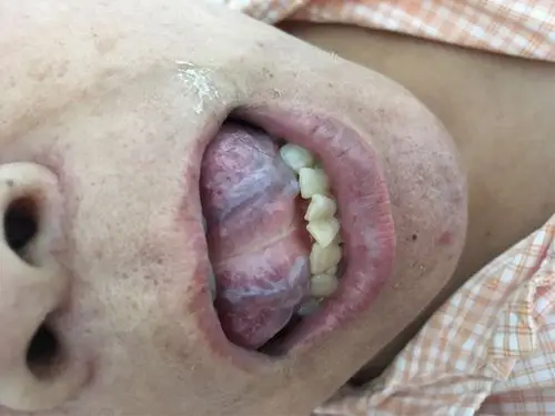 看舌下的静脉血管已经堵很利害,看到心脑血管很多毒素.