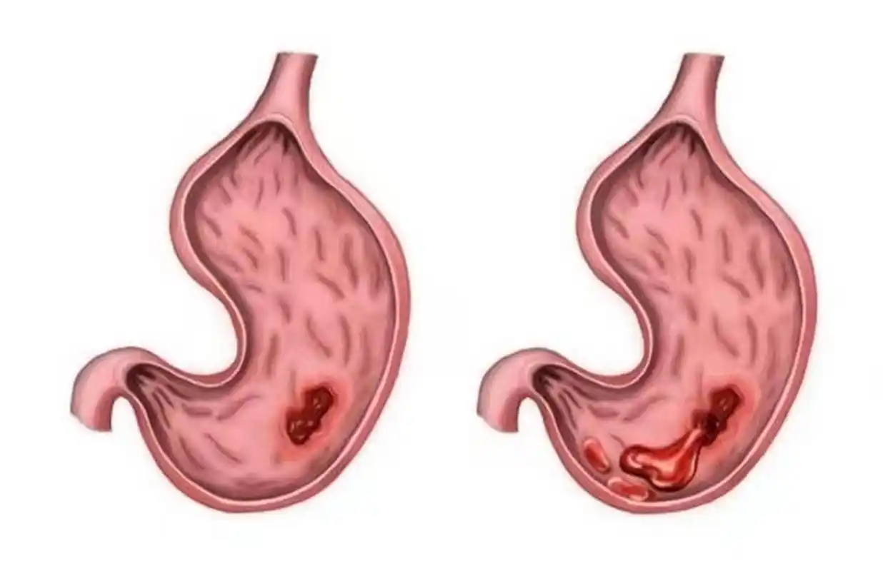 一般情况下,糜烂性胃炎是否严重?