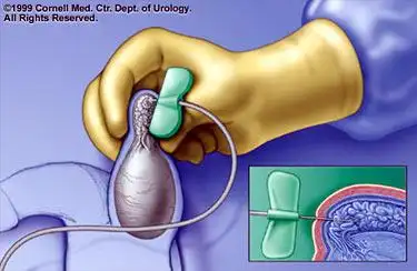 适应人群 是否住院 费用 经皮附睾穿刺抽吸术(pesa) 经皮睾丸穿刺抽吸