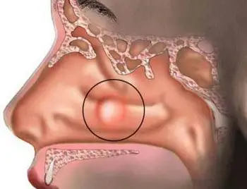 疾病中心 鼻息肉 症状鼻息肉与鼻腔壁或鼻窦内的慢性感染 (慢性鼻窦炎