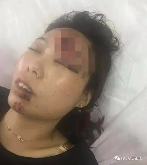 【扩散】澄海某地车祸,30岁女子刚离完婚被撞昏迷,急寻肇事者!