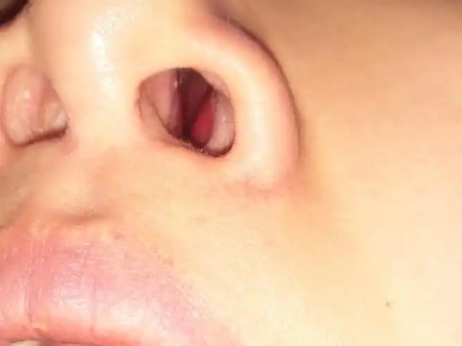 鼻子做了差2个月有1年了,我今天才看到鼻子里面这个_圈子-新氧美容