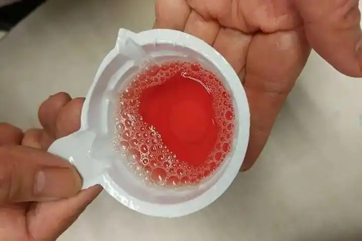 紫癜严重的图片