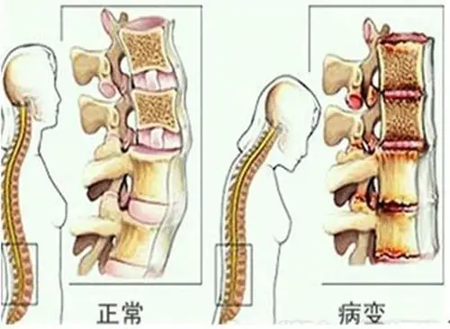 胸椎关节错位了怎么办