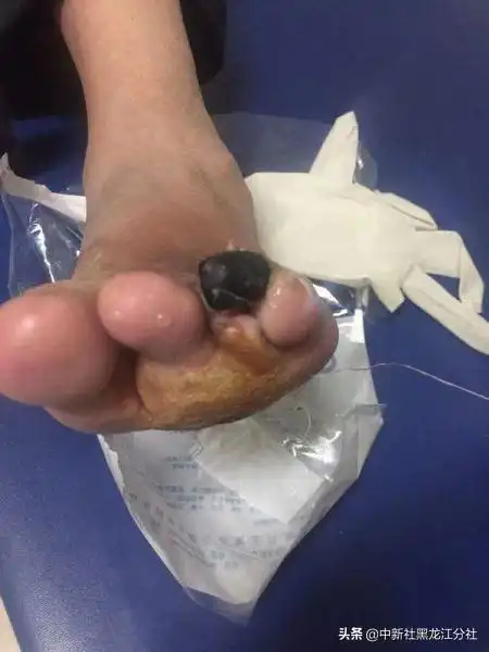 鞋子挤压脚趾甲发黑的症状及缓减治疗