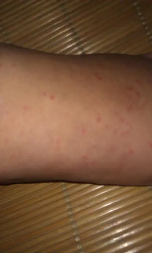脚上长了红点,有点痒,请问是什么,怎么治?