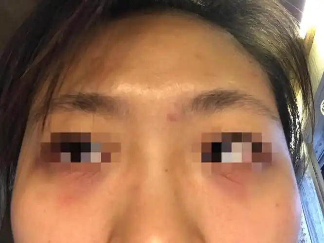 眼下突然出现爆皮细纹