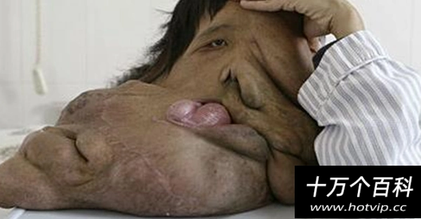 世界上长得最恐怖的人湖南象人黄春才脸上15公斤神经纤维瘤