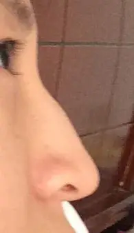 自从戴了眼镜以后,现在发现鼻子中间地方骨头突起怎么办,有什么方法