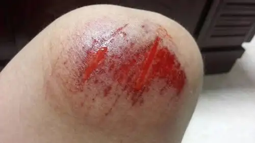 膝盖摔伤,需要用药吗,还是让它自愈就好