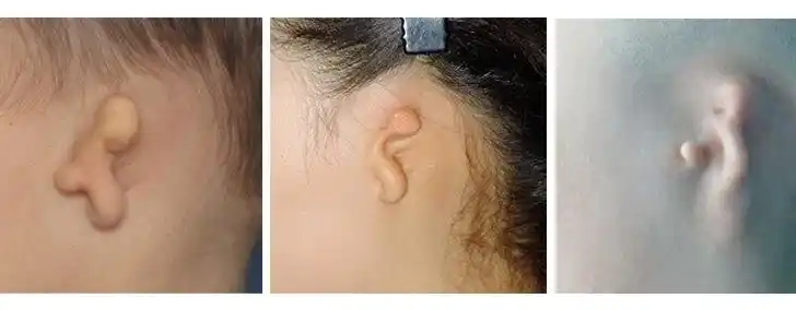 为什么有的孩子生出来没耳朵? (原创)_畸形