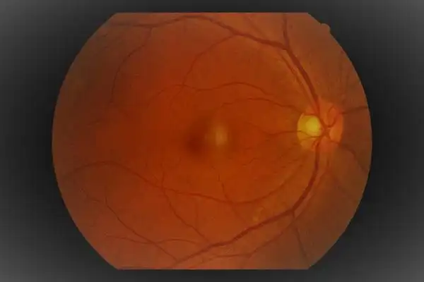 那么,通过眼底视神经照片,我们怎么去判断哪些人是可疑的青光眼患者呢